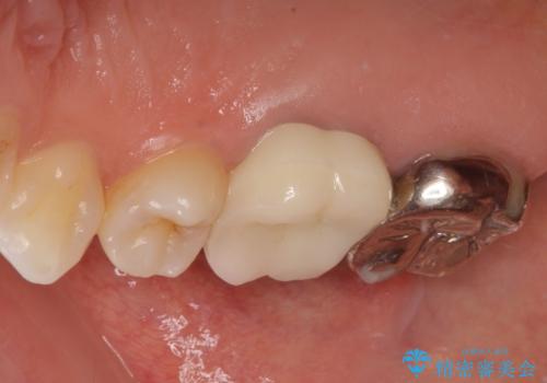 金属の詰め物が取れた。セラミックを入れたい! オールセラミッククラウンの治療後
