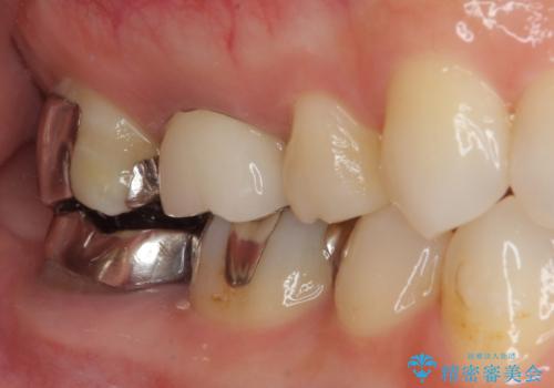 金属の詰め物が取れた。セラミックを入れたい! オールセラミッククラウンの治療後