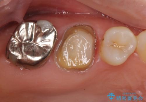 金属の詰め物が取れた。セラミックを入れたい! オールセラミッククラウンの治療中