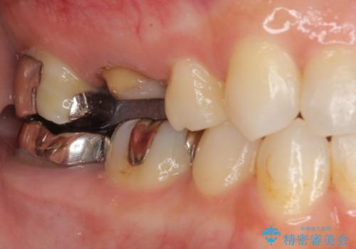 金属の詰め物が取れた。セラミックを入れたい! オールセラミッククラウンの治療中