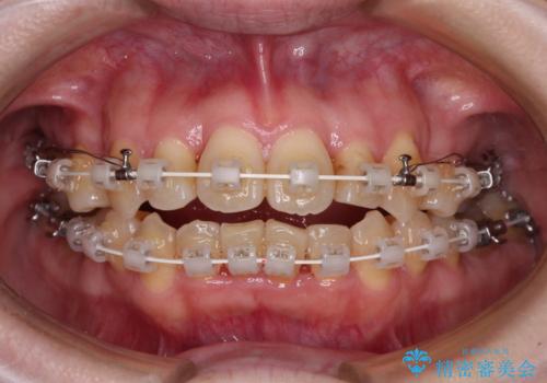 飛び出した上顎前歯と上下のデコボコ 片顎の抜歯によるワイヤー矯正の治療中