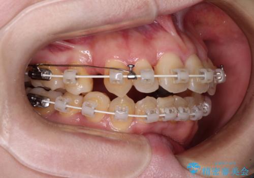飛び出した上顎前歯と上下のデコボコ 片顎の抜歯によるワイヤー矯正の治療中
