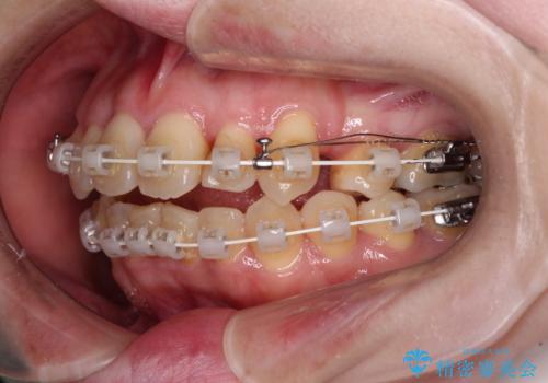 飛び出した上顎前歯と上下のデコボコ 片顎の抜歯によるワイヤー矯正の治療中