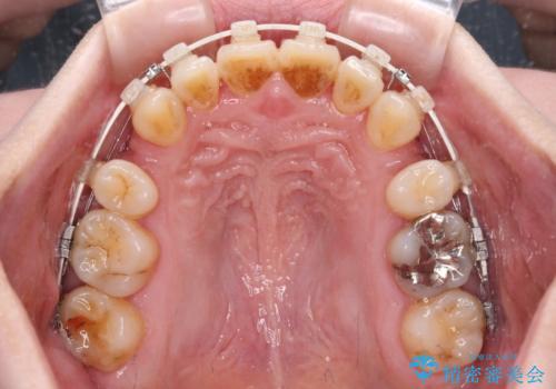飛び出した上顎前歯と上下のデコボコ　片顎の抜歯によるワイヤー矯正の治療中
