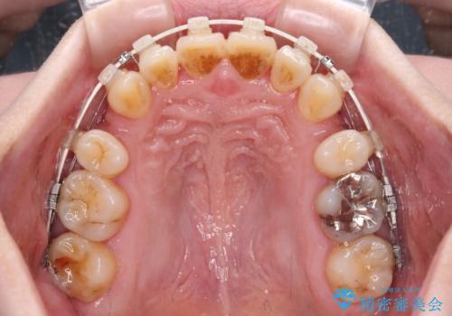 飛び出した上顎前歯と上下のデコボコ 片顎の抜歯によるワイヤー矯正の治療中