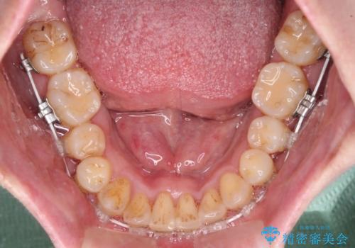 飛び出した上顎前歯と上下のデコボコ 片顎の抜歯によるワイヤー矯正の治療中