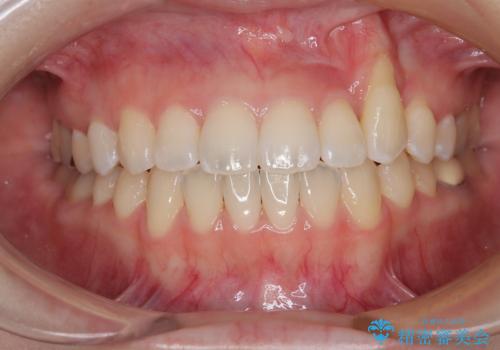 急速拡大装置　狭い上顎骨を拡大してワイヤー装置で八重歯を短期間治療の症例 治療後