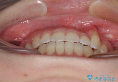 急速拡大装置 狭い上顎骨を拡大してワイヤー装置で八重歯を短期間治療の治療後