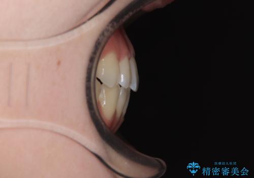 急速拡大装置 狭い上顎骨を拡大してワイヤー装置で八重歯を短期間治療の治療後