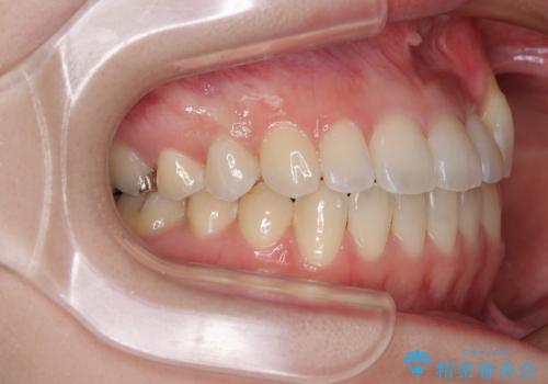 急速拡大装置 狭い上顎骨を拡大してワイヤー装置で八重歯を短期間治療の治療後