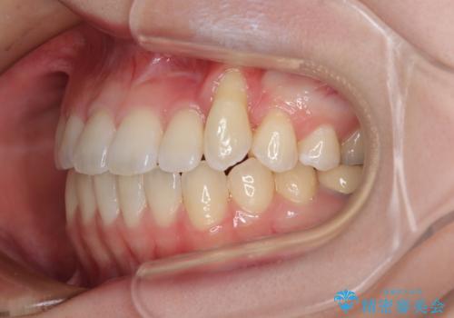 急速拡大装置 狭い上顎骨を拡大してワイヤー装置で八重歯を短期間治療の治療後