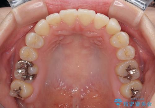 急速拡大装置　狭い上顎骨を拡大してワイヤー装置で八重歯を短期間治療の治療後