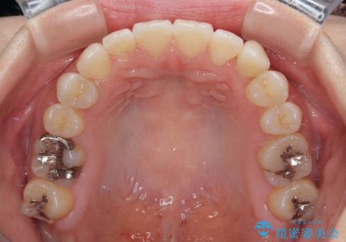 急速拡大装置 狭い上顎骨を拡大してワイヤー装置で八重歯を短期間治療の治療後