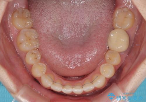 急速拡大装置 狭い上顎骨を拡大してワイヤー装置で八重歯を短期間治療の治療後