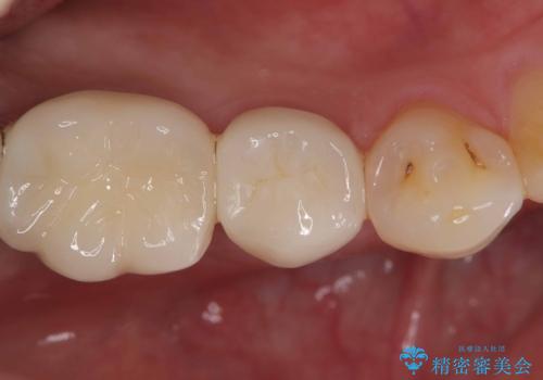 【オールセラミッククラウン】食事をしていたら歯が欠けた!