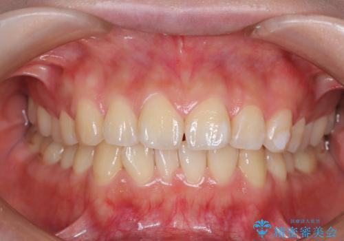出っ歯、がたつきを治したい マウスピース矯正の症例 治療前