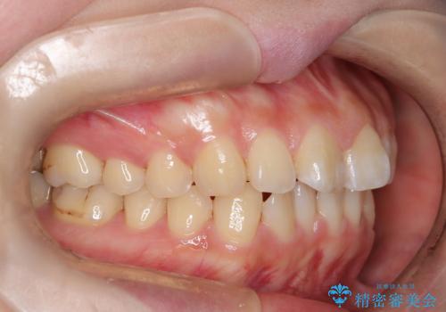 出っ歯、がたつきを治したい マウスピース矯正の治療前