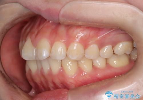 出っ歯、がたつきを治したい マウスピース矯正の治療前