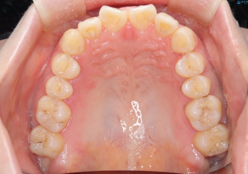 出っ歯、がたつきを治したい マウスピース矯正の治療前