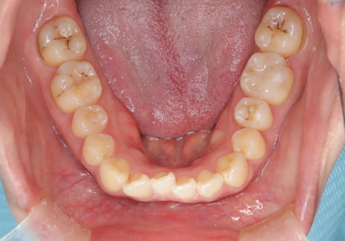 出っ歯、がたつきを治したい マウスピース矯正の治療前