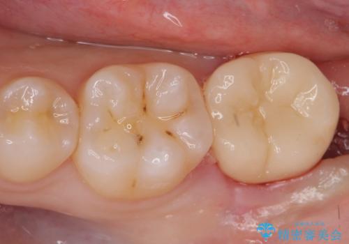 左奥歯が痛い。(親知らず抜歯 ジルコニアクラウン)の症例 治療後