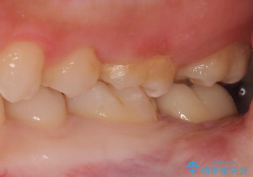 左奥歯が痛い。(親知らず抜歯 ジルコニアクラウン)の治療後