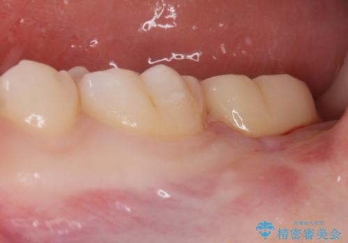 左奥歯が痛い。(親知らず抜歯 ジルコニアクラウン)の治療後
