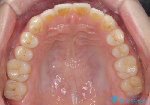 前歯が気になる。インビザラインライトの治療後