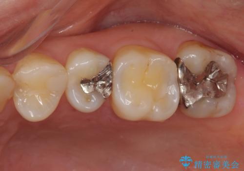 奥歯の銀歯をゴールドでしっかりと治療の治療前