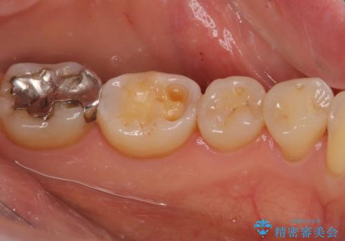 奥歯の銀歯をゴールドでしっかりと治療の治療前