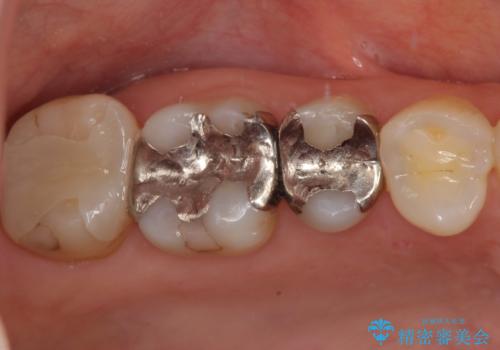 奥歯の銀歯をゴールドでしっかりと治療の症例 治療前