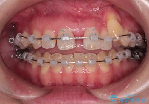 急速拡大装置　狭い上顎骨を拡大してワイヤー装置で八重歯を短期間治療の治療中