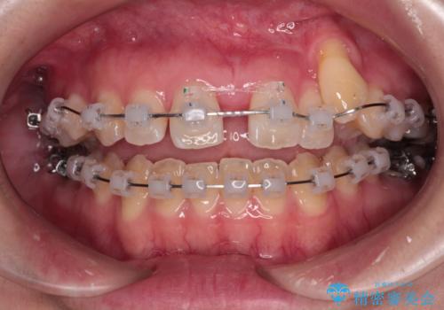 急速拡大装置 狭い上顎骨を拡大してワイヤー装置で八重歯を短期間治療の治療中