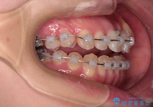 急速拡大装置 狭い上顎骨を拡大してワイヤー装置で八重歯を短期間治療の治療中