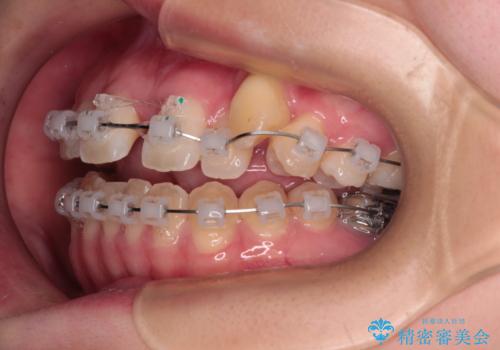 急速拡大装置 狭い上顎骨を拡大してワイヤー装置で八重歯を短期間治療の治療中
