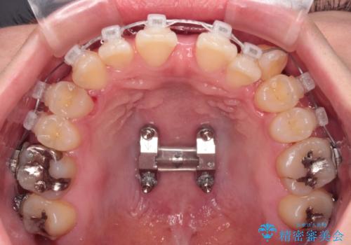 急速拡大装置　狭い上顎骨を拡大してワイヤー装置で八重歯を短期間治療の治療中
