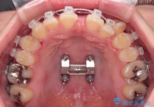 急速拡大装置 狭い上顎骨を拡大してワイヤー装置で八重歯を短期間治療の治療中