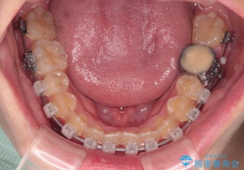 急速拡大装置 狭い上顎骨を拡大してワイヤー装置で八重歯を短期間治療の治療中