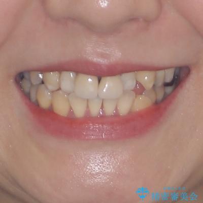 気になる前歯 ワイヤー矯正とセラミック治療の治療前(顔貌)