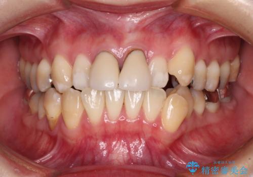 気になる前歯 ワイヤー矯正とセラミック治療の症例 治療前