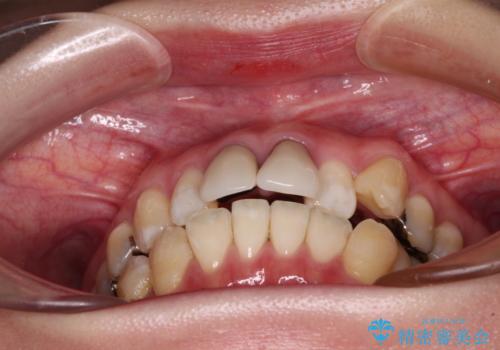 気になる前歯 ワイヤー矯正とセラミック治療の治療前