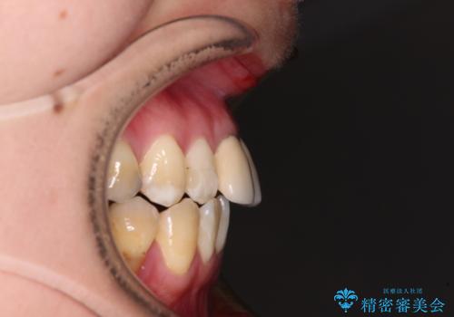 気になる前歯 ワイヤー矯正とセラミック治療の治療前