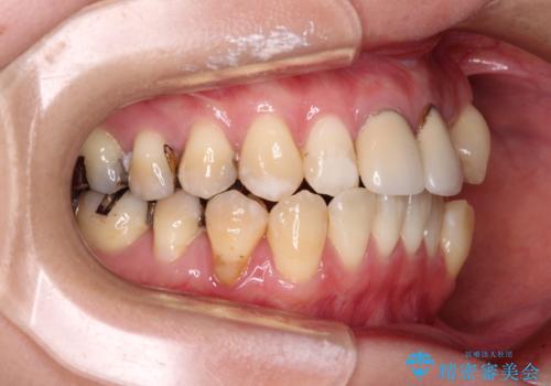 気になる前歯 ワイヤー矯正とセラミック治療の治療前