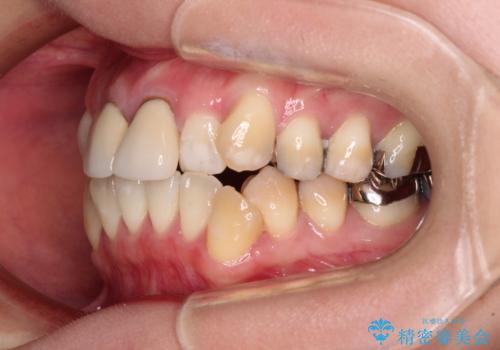 気になる前歯 ワイヤー矯正とセラミック治療の治療前