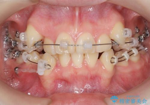 [ 八重歯を治す ]   小臼歯4本抜歯 マルチブラケット矯正の治療前