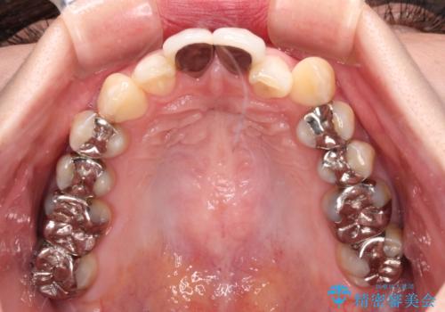 気になる前歯 ワイヤー矯正とセラミック治療の治療前