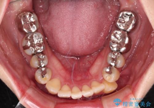 気になる前歯 ワイヤー矯正とセラミック治療の治療前