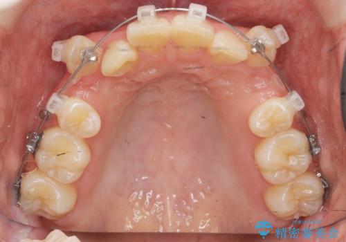 [ 八重歯を治す ]   小臼歯4本抜歯 マルチブラケット矯正の治療前