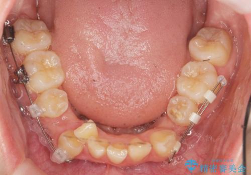 [ 八重歯を治す ]   小臼歯4本抜歯 マルチブラケット矯正の治療前