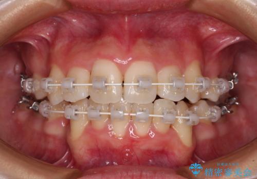 デコボコと出っ歯 抜歯矯正でスッキリとした口元にの治療中